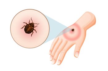 кліщ, укус кліща, хвороба Лайма