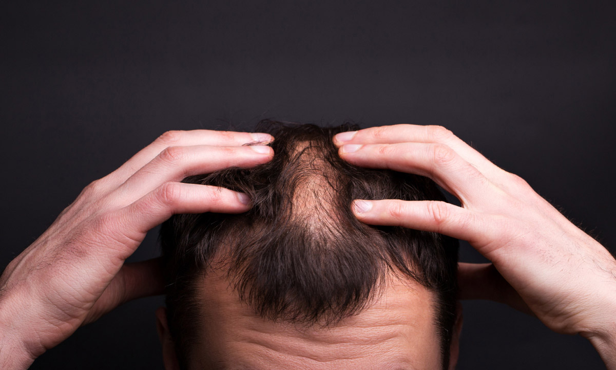 чоловік з рідким волоссям, перша стадія облисіння