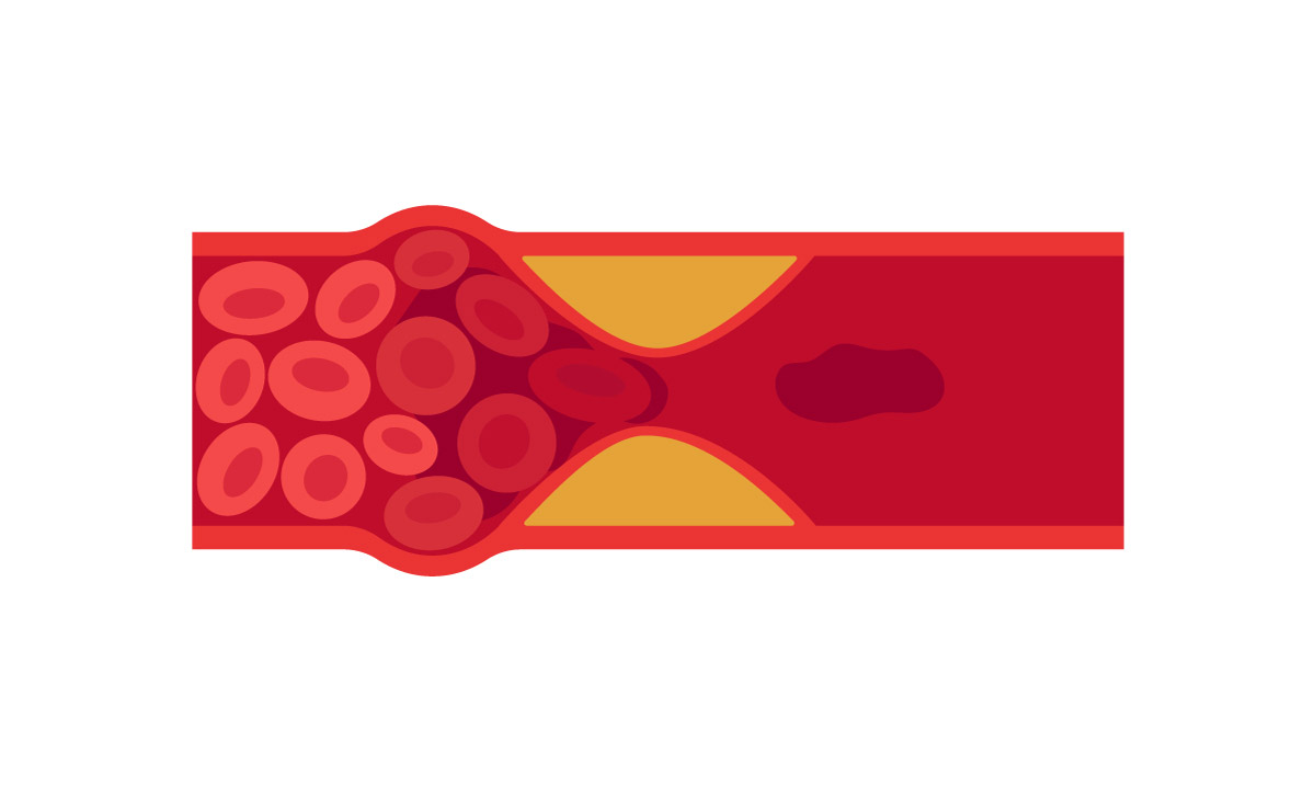 сехматичне зображення судини з кров'ю, тромбоцитами, та умовним холестерином, який звужує просвіт