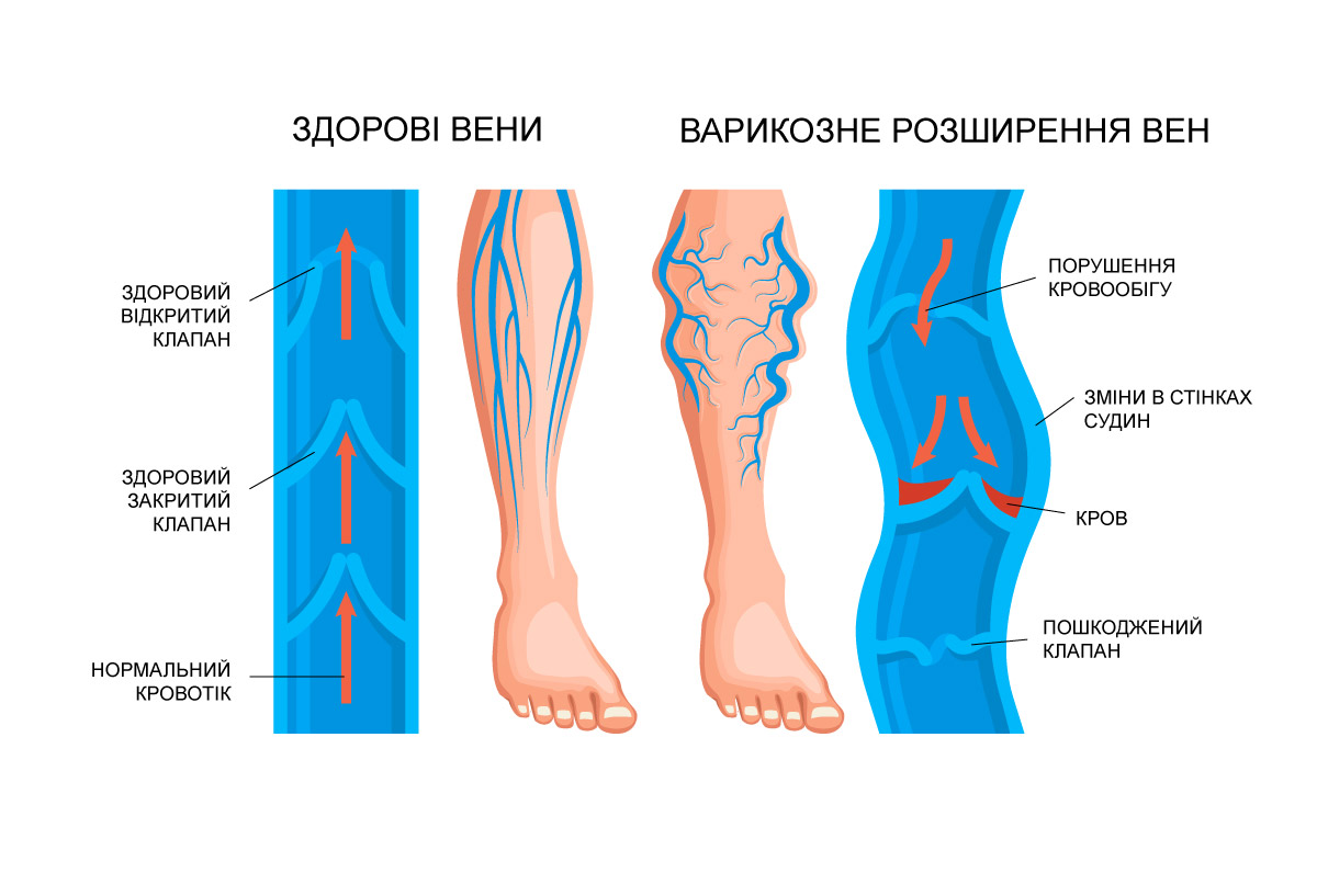 графічне зображення негативних венозних змін в нижніх кінцівках