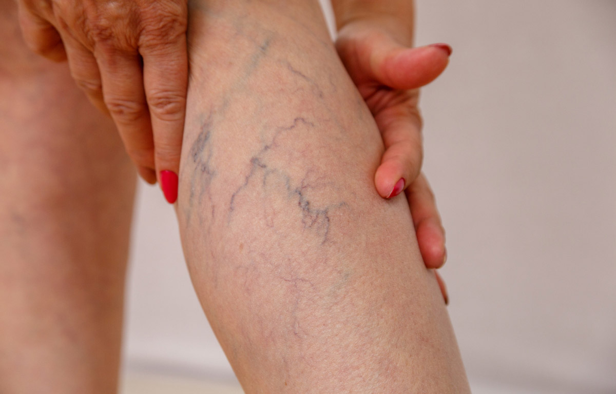 зображення венозної сіточки на ногах жінки