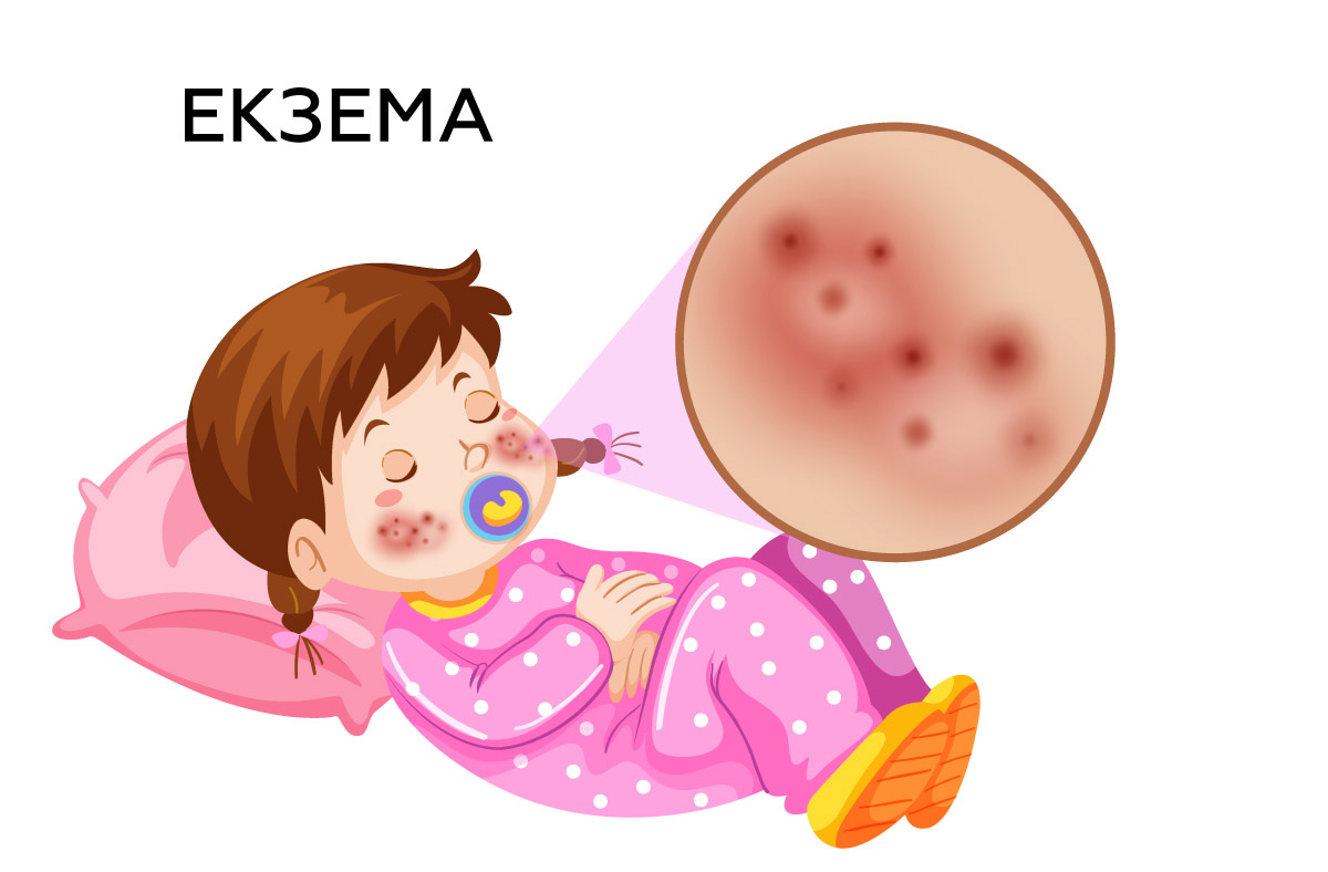 ілюстрація дитини з екземою, у дівчинки висипи на щоках