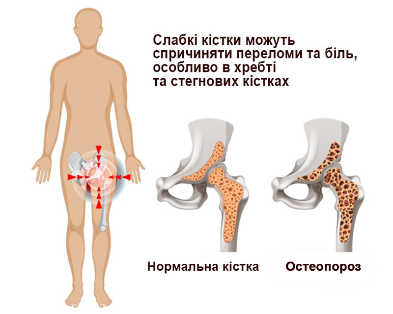 ілюстрація кістки стегна, та її вигляд у здоровому та уражену остеопорозом станах