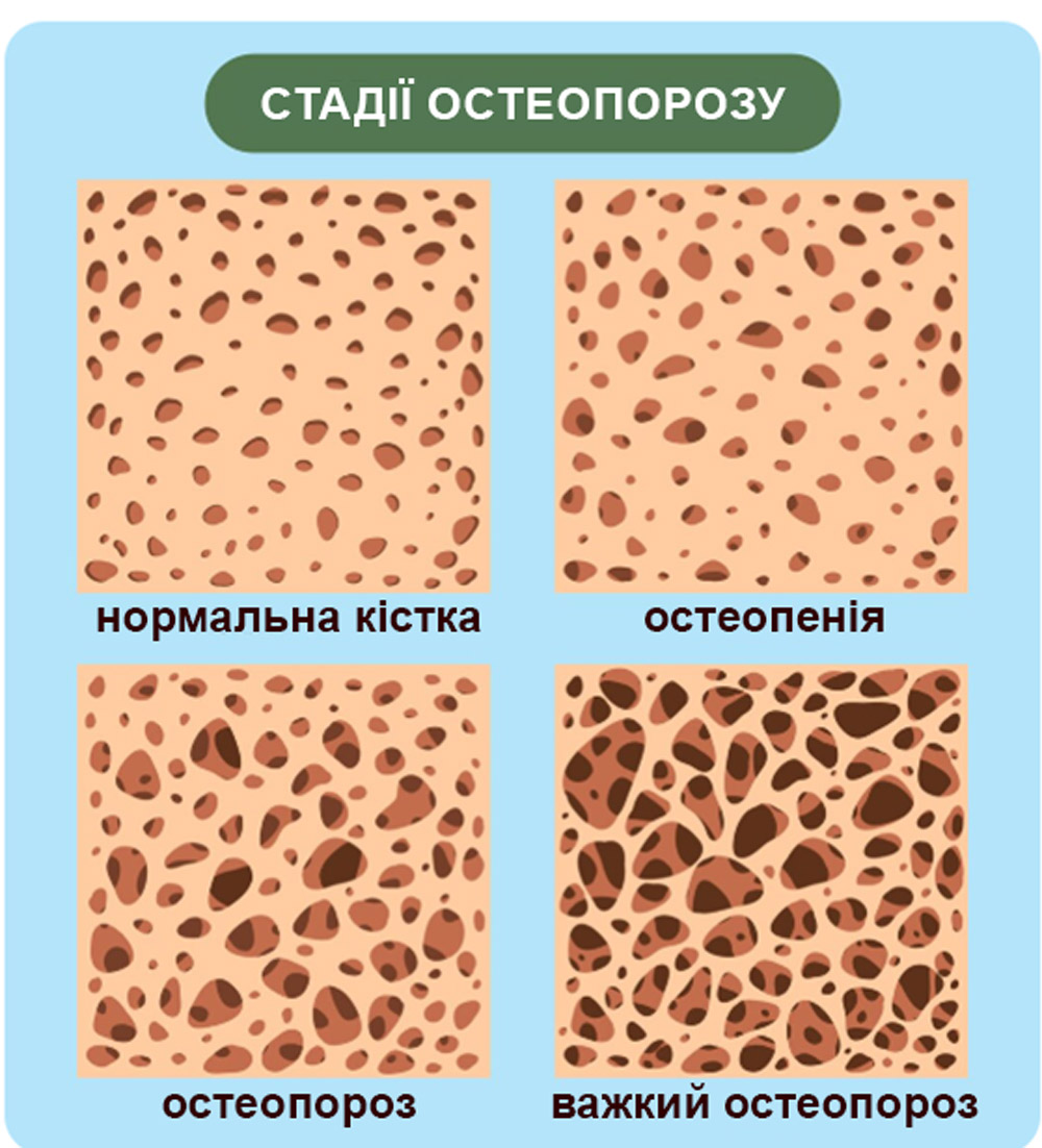 ілюстрація стадій остеопорозу, зображення їх шляхом ілюстрації стану кісток