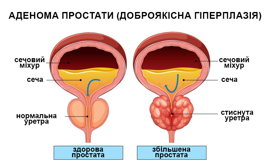 ілюстративне зображення механізму запалення простати та його вплив на найближчі органи