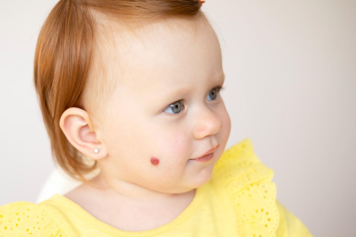 маленька дитина з ангіомою на щоці