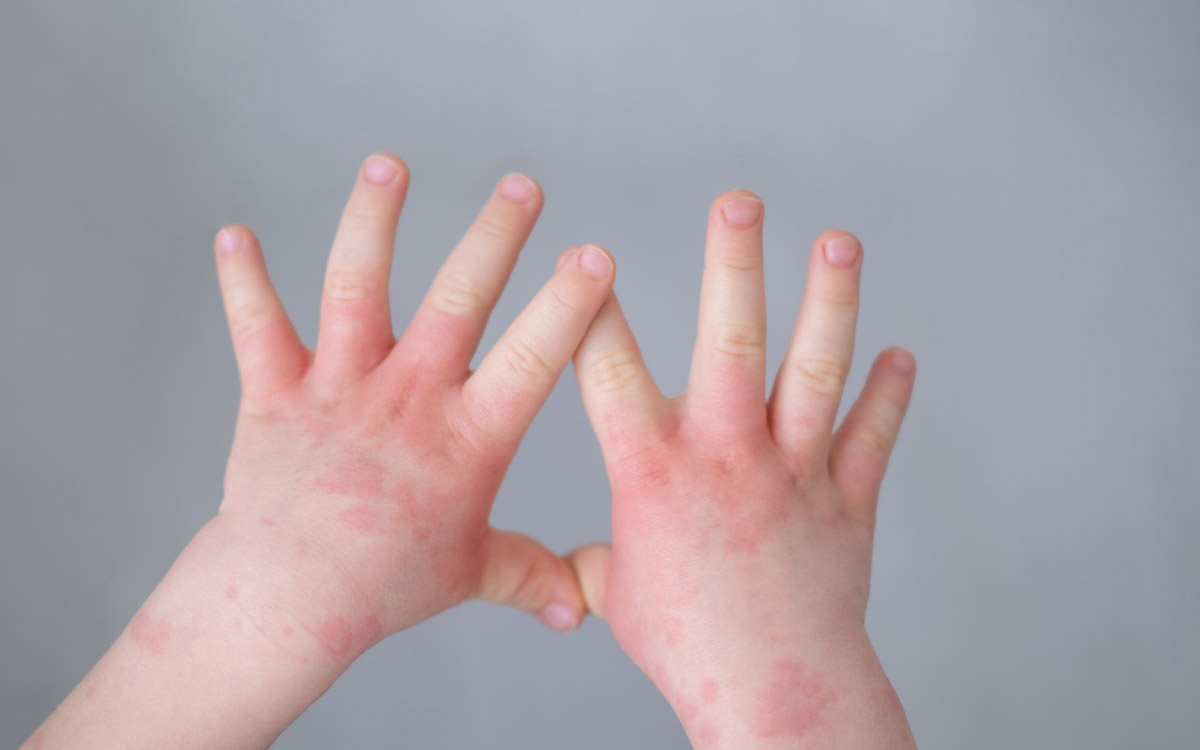 ручки дитини зблизька, на них видно наявність висипу та почервонінь