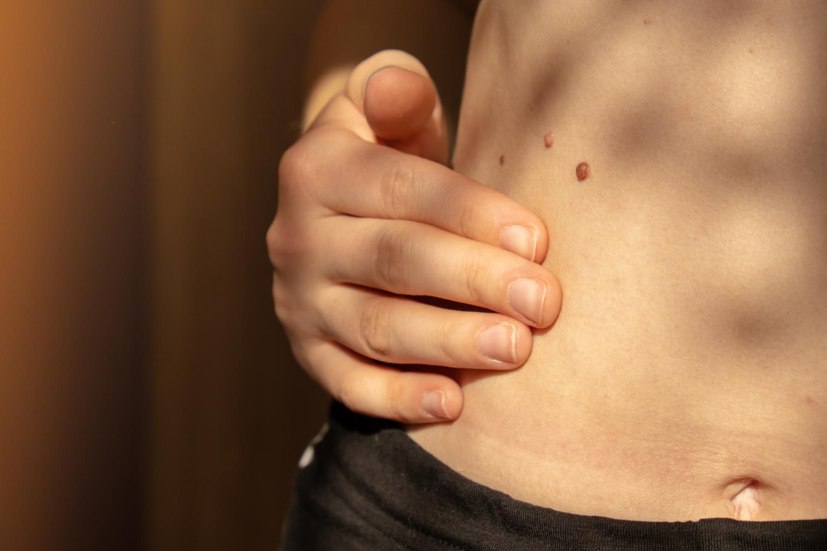 живіт людини з родимками