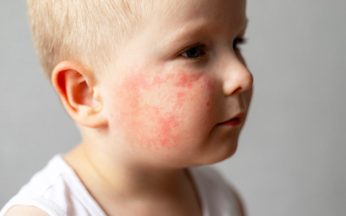 зображення алергічного висипу на щоках дитинки