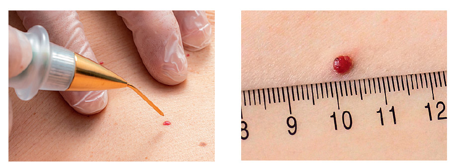 зображення процесу вимірювання родимки