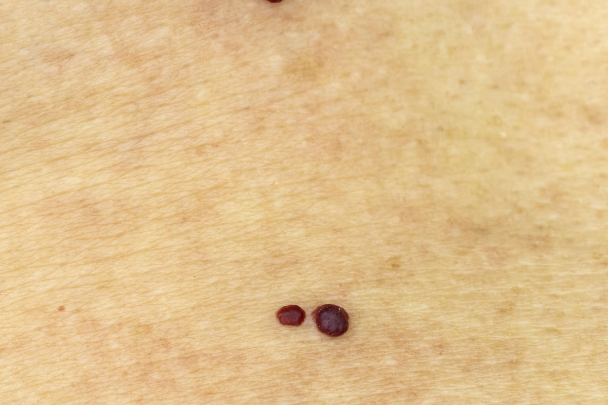 зображення родимок на шкірі