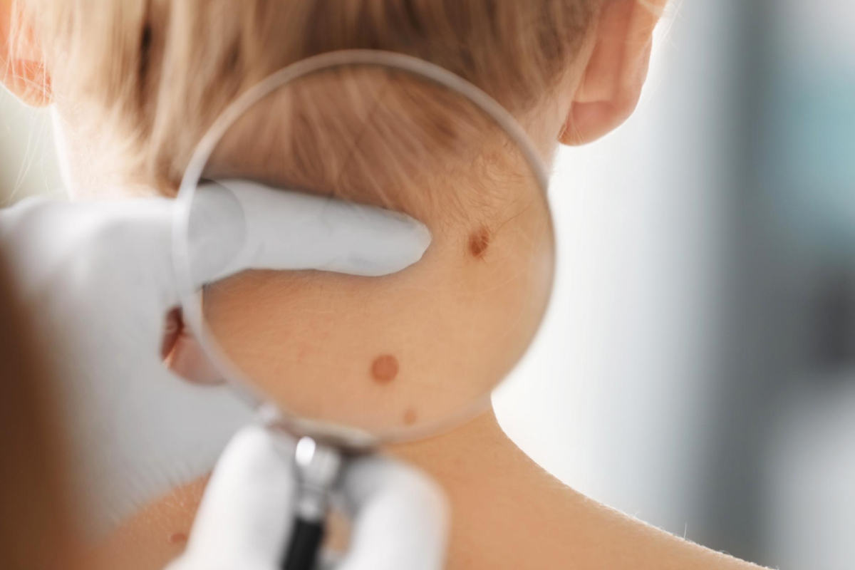 зображення родимок на шиї, які збільшено завдяки лупі