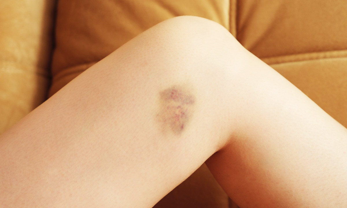 синець на нозі