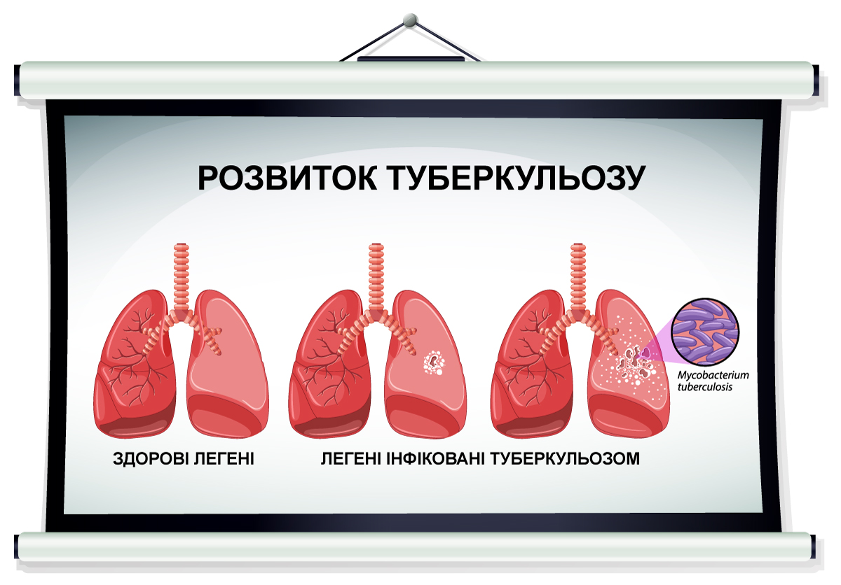 стадії розвитку туберкульозу, зображення легень мальоване