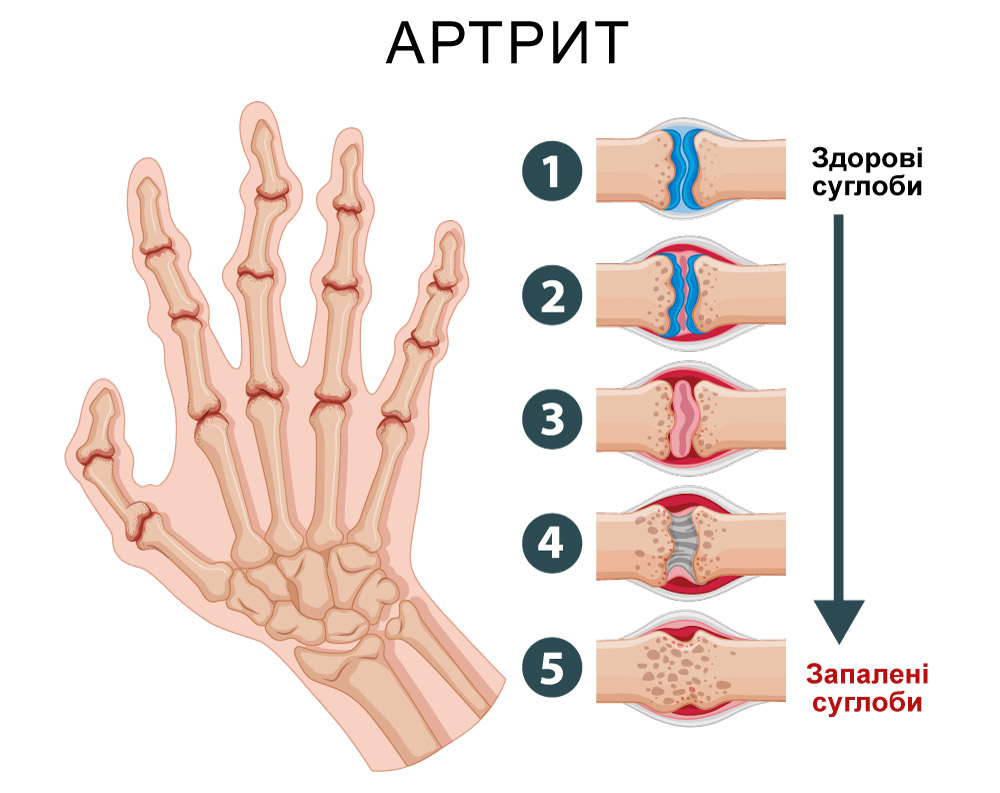мальоване схематичне зображення етапів виникнення артриту