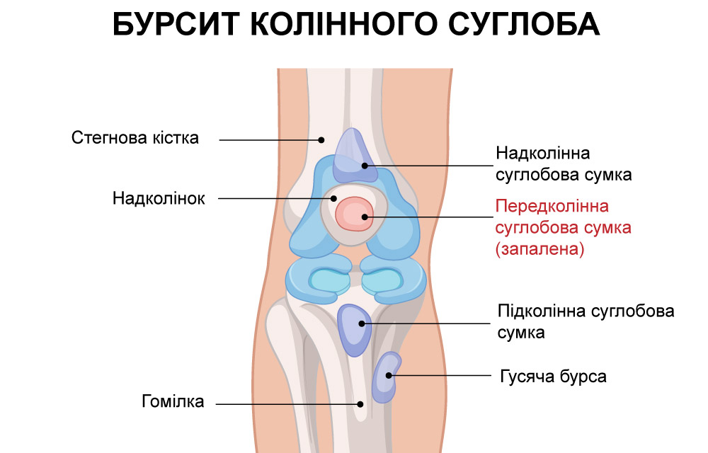 мальоване схематичне зображення того, як виглядає бурсит коліна