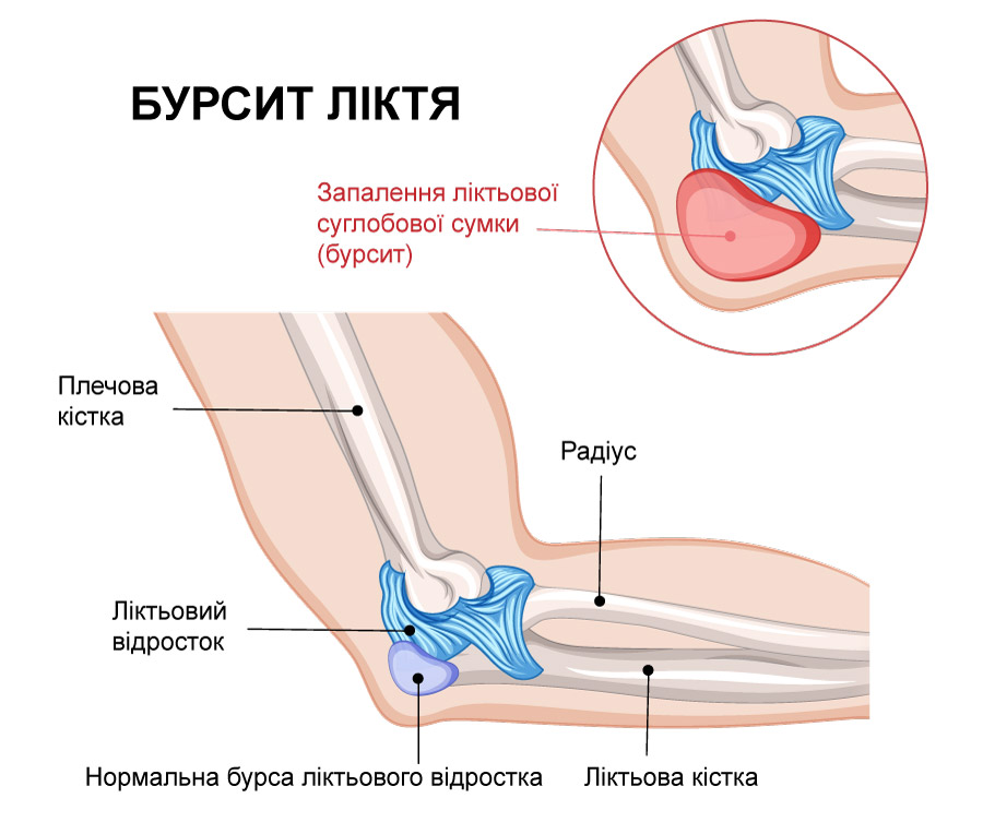 мальоване схематичне зображення того, як виглядає бурсит ліктя