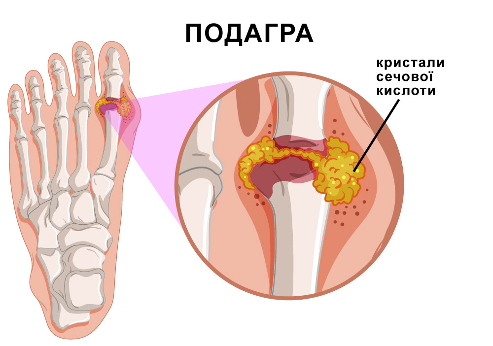 мальоване зображення того, як виглядає подагра