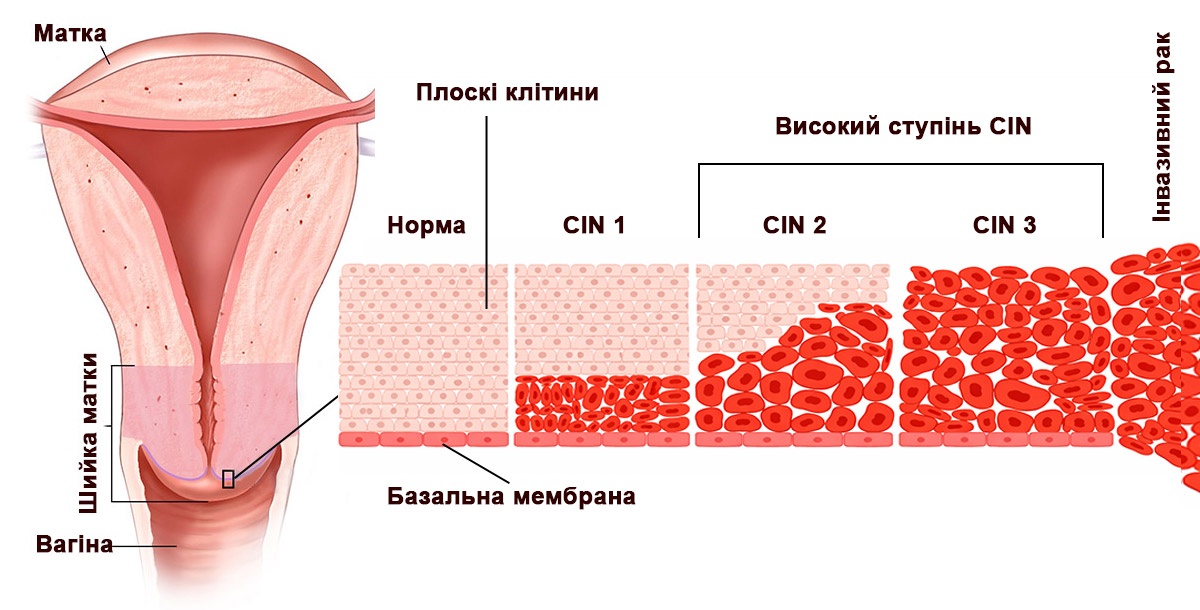 зображення ураження клітин шийки матки - дисплазія