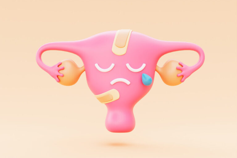 Аденоміоз. Яку небезпеку несе жіночому здоров’ю