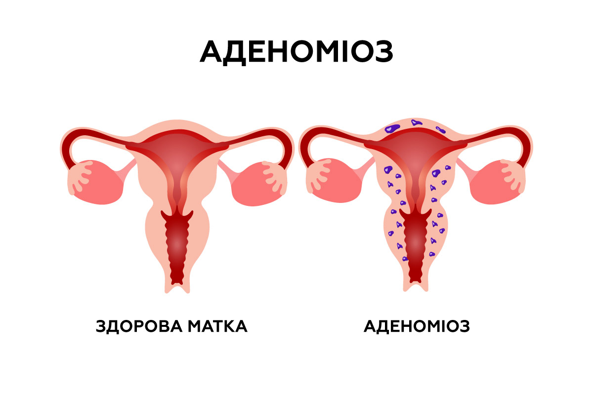 аденоміоз та здорова матка (малюнок)