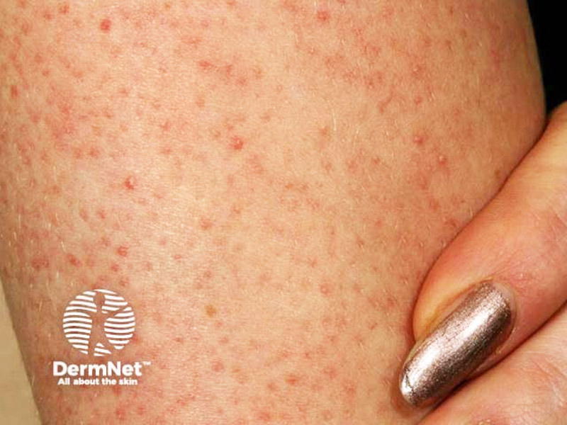 фоллікулярний кератоз