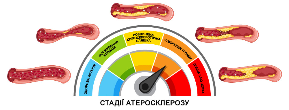 ліпідограма - інфографіка-2 