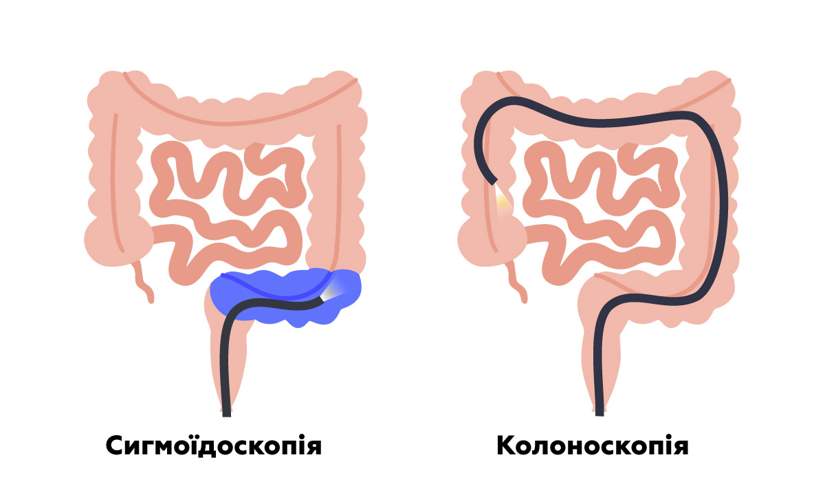 колоноскопія та сигмоскопія