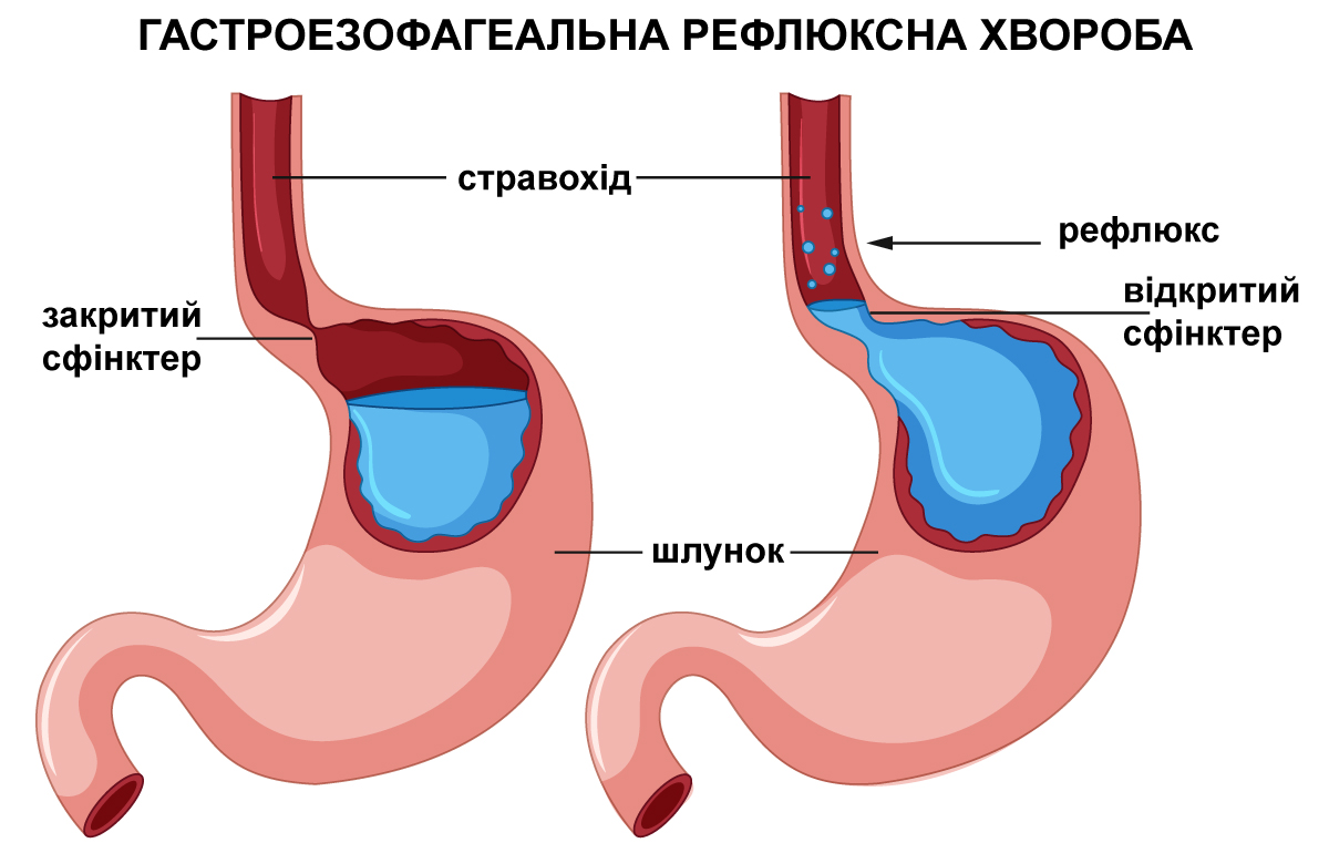 рефлюксна хвороба