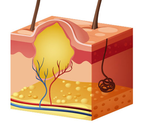 схематичне зображення розрізу шкіри для демонстрації вигляду атероми