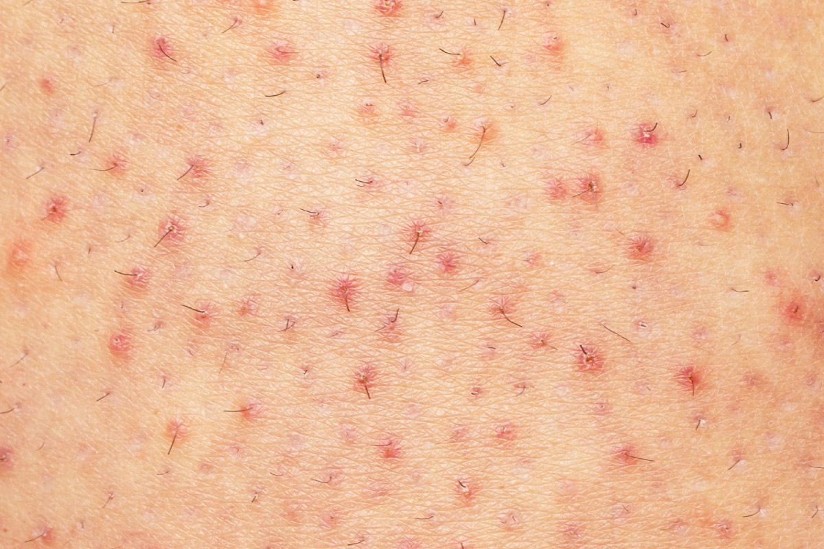 шкіра з проявами фолікуліту