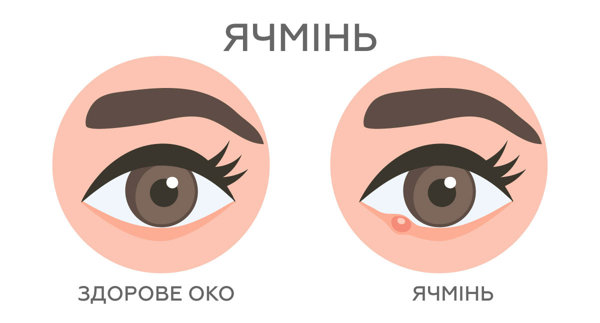 зображення місця розташування ячменю на очах