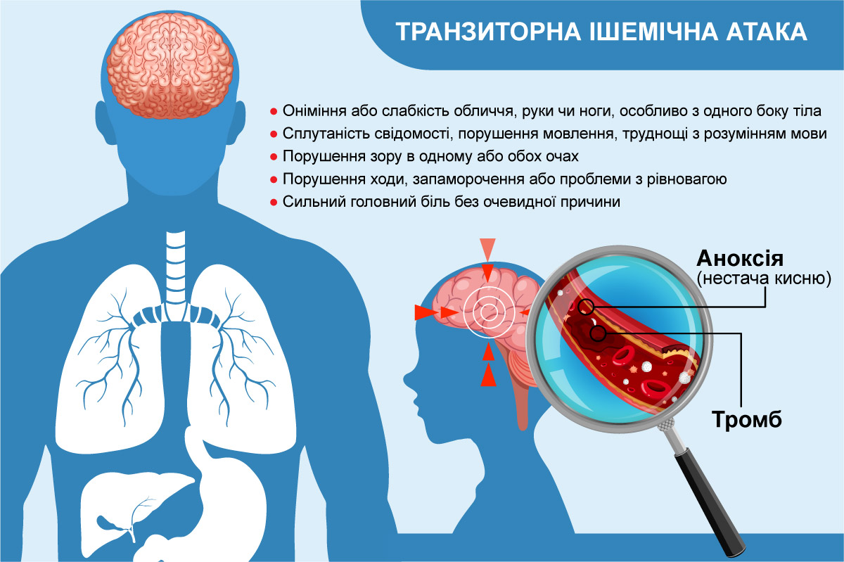 Ішемічна атака. Що це
