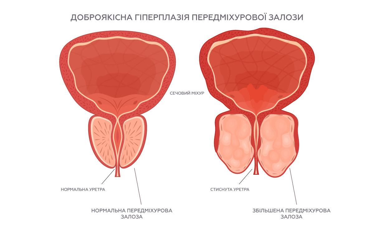 доброякісна гіперплазія передміхурової залози