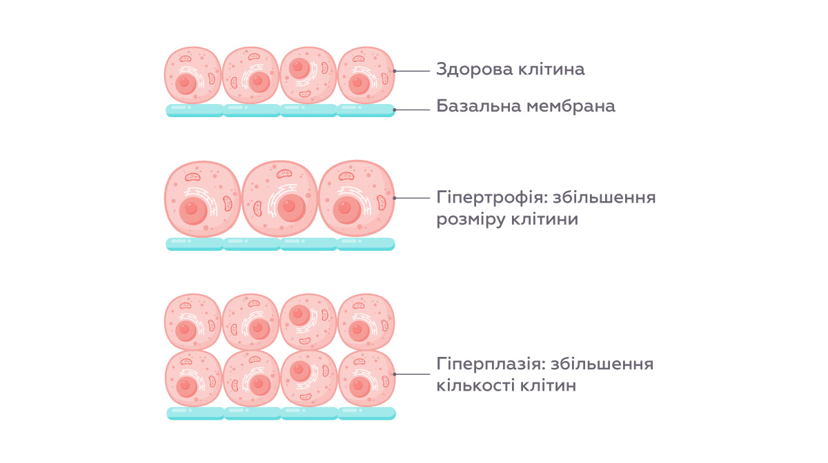 гіперплазія схематично