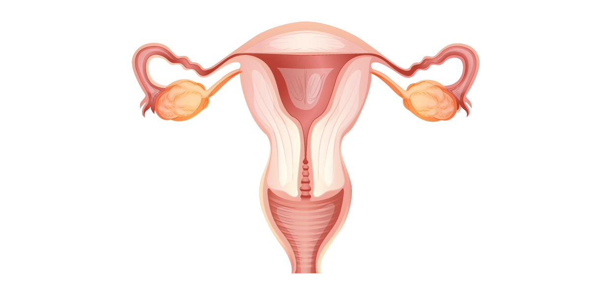 гіперплазія яєчника