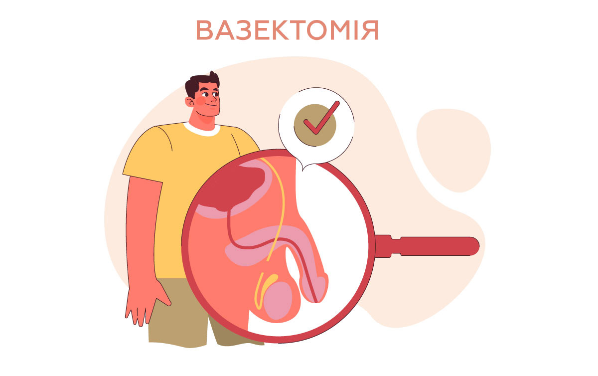 мальоване схематичне зображення суті вазектомії