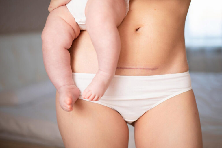 Що таке кесарів розтин і коли його роблять?