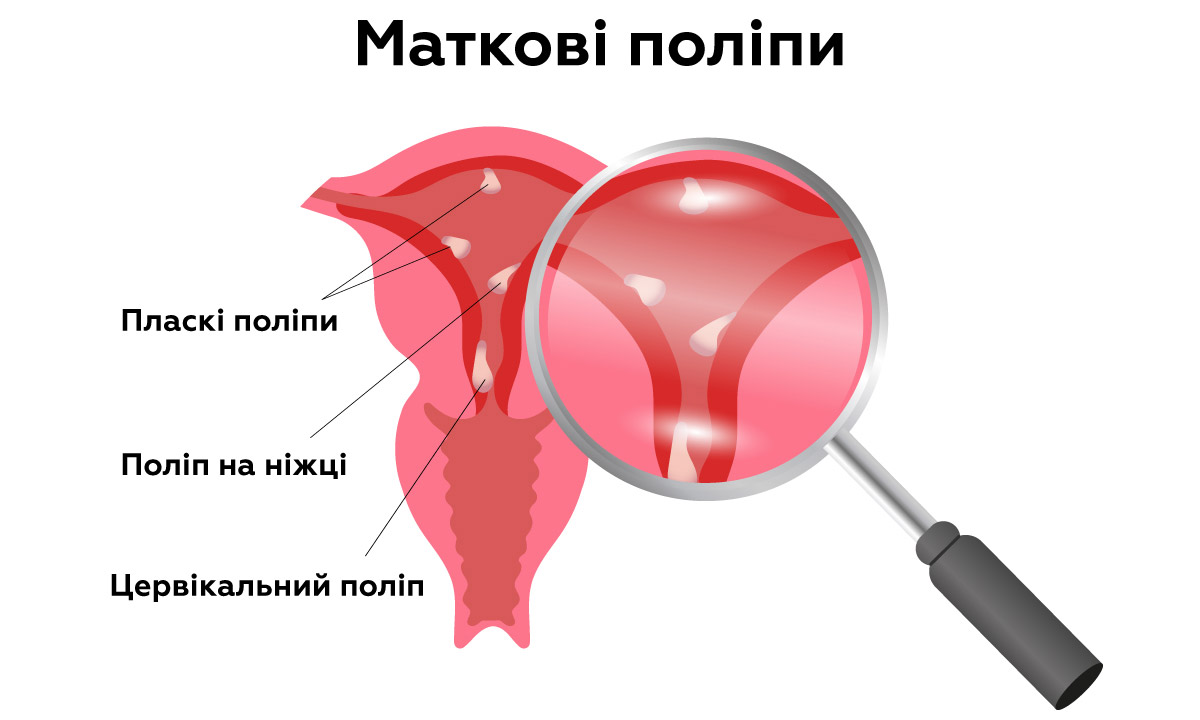 маткові поліпи