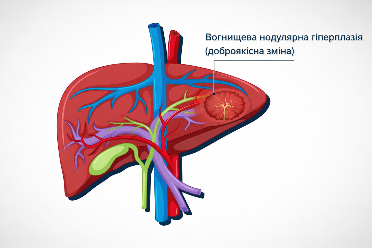 нодулярна гіперплазія