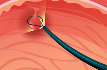 петля для видалення поліпа