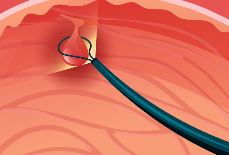 Що таке поліпи та які органи вони вражають