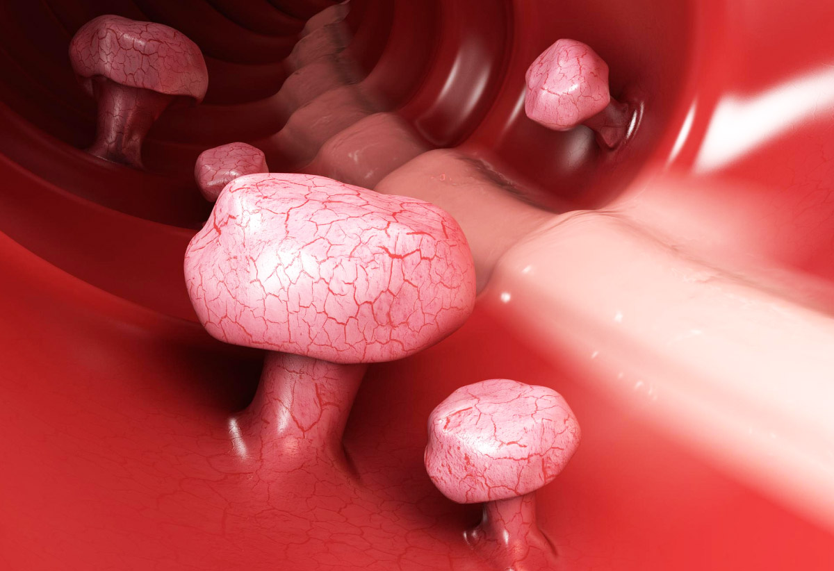 поліпи на колоноскопії, 3D-проекція