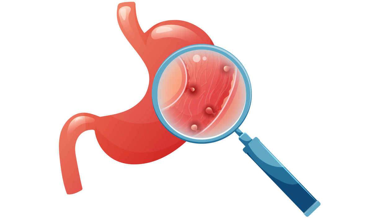 поліпи в шлунку