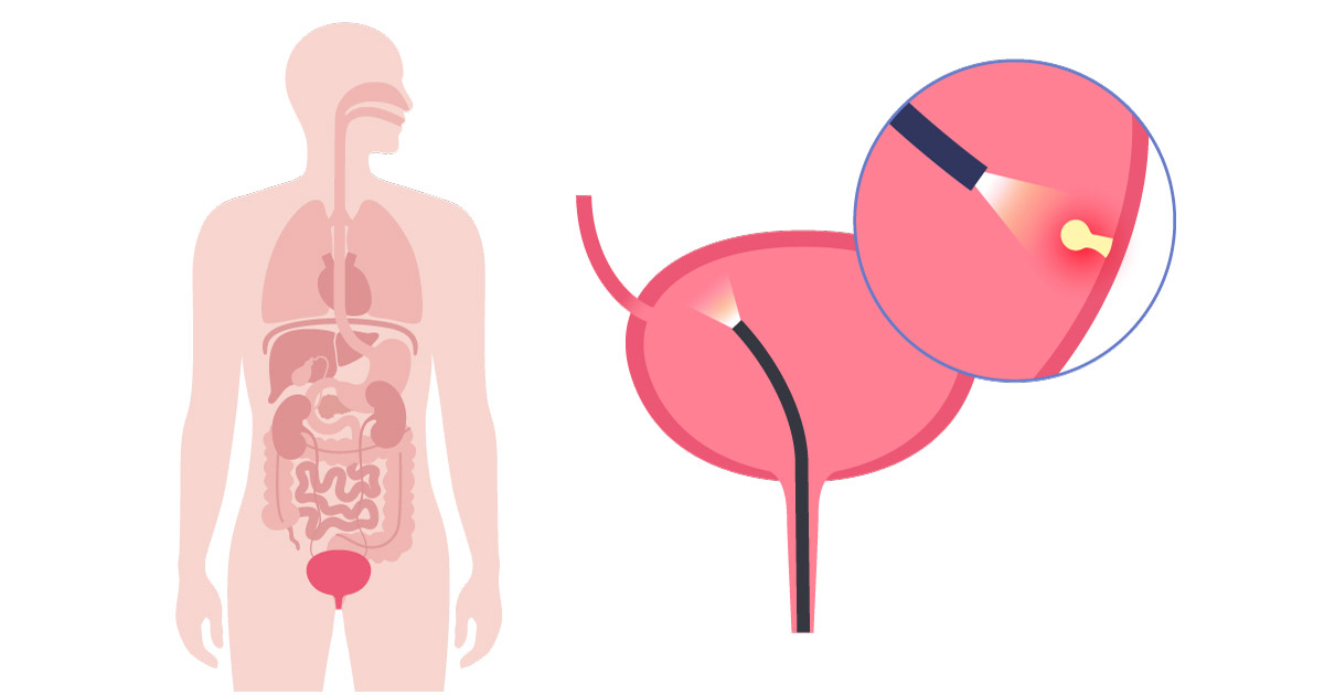 проведення кольпоскопії, схема