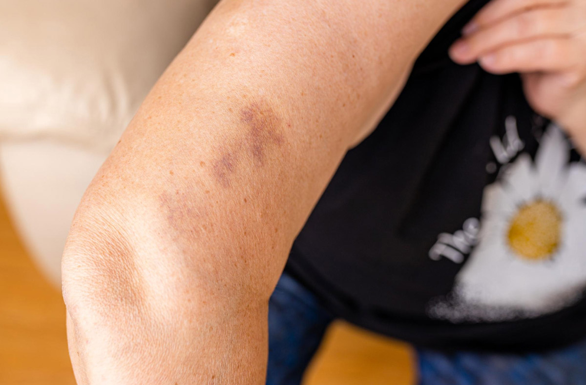 синці на руці