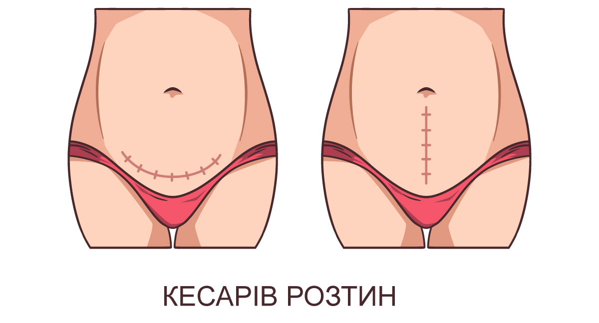 вертикальний та горизонтальний розрізи кесаревого розтину
