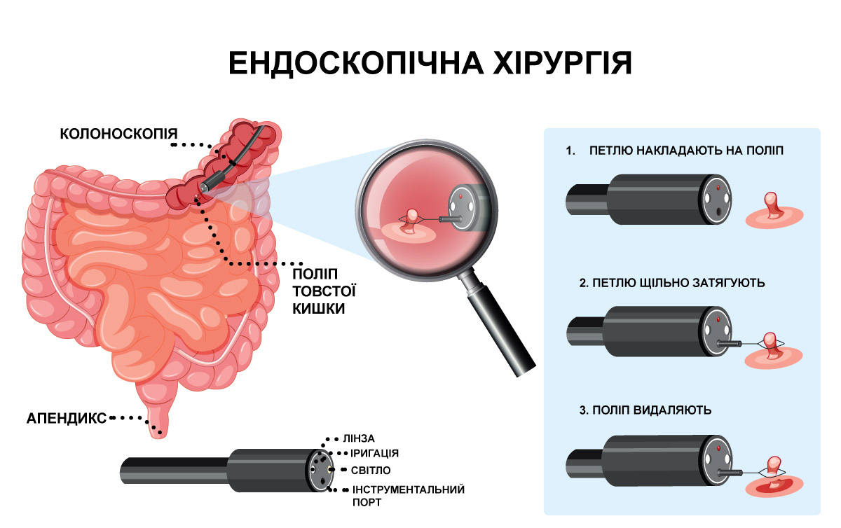 видалення поліпа ендоскопічне