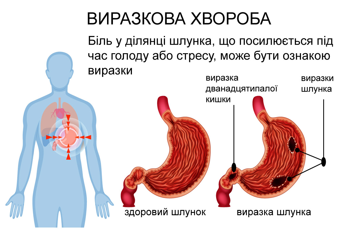 виразкова хвороба