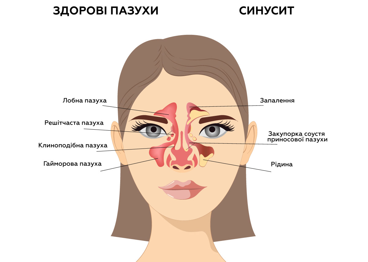 як виглядає гайморит всередині